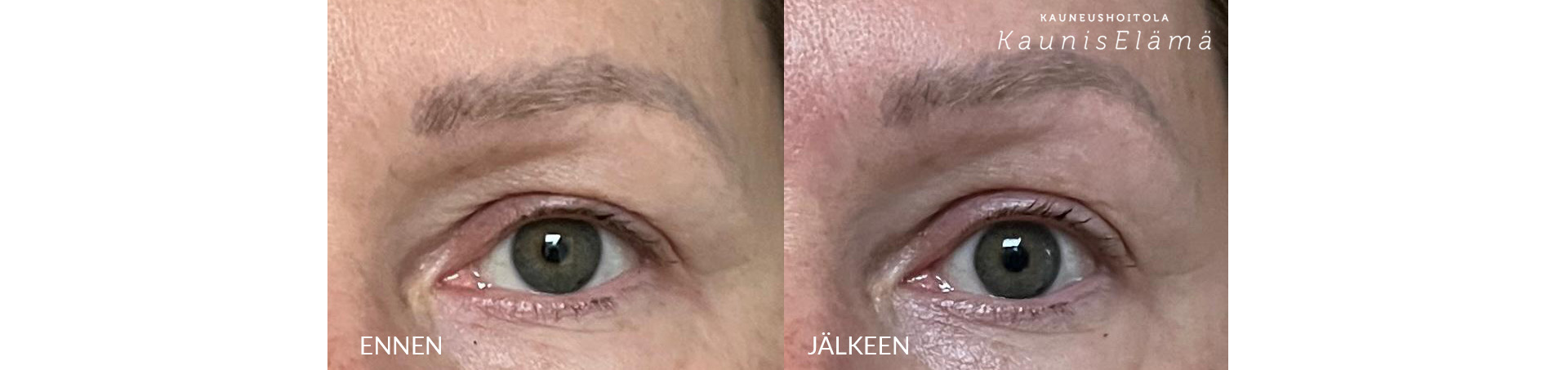 Yin_Your_Skin_gua sha_ennen ja jälkeen Kauneushoitola KaunisElämä Yin_Your_Skin_gua-sha_ennen-ja-jalkeen-Kauneushoitola-KaunisElama.jpg